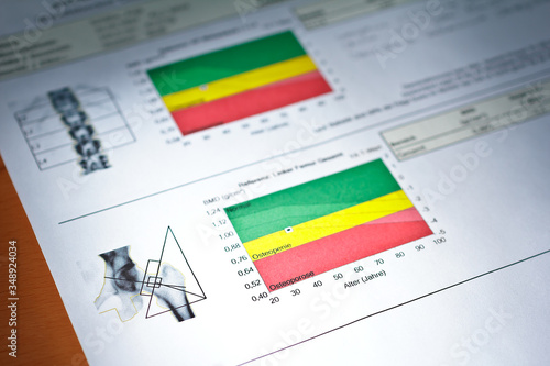 Knochendichtemessung: dxa bone density scan in a woman of 42 years, german text.