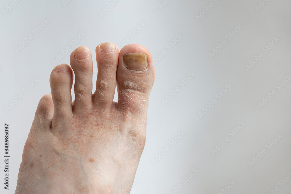 Mans feet with nail fungus and pitted keratolysis on gray background