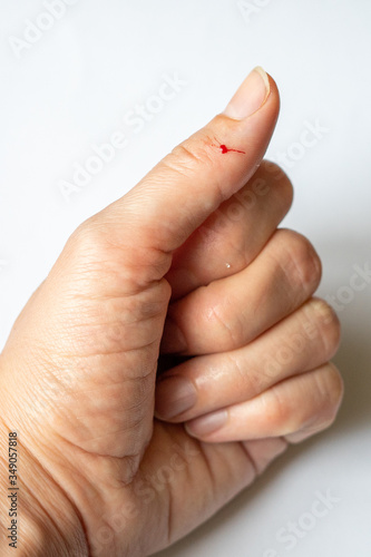 a finger on his hand was accidentally wounded with a knife