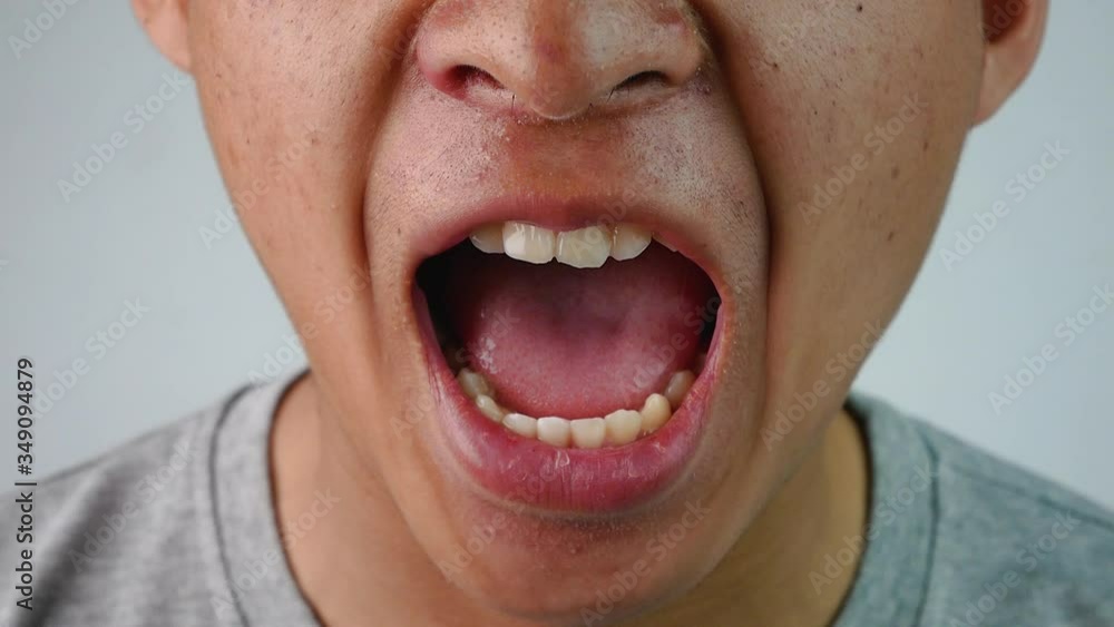 Close up face of Asian teenage guy with a problem of abnormal tooth structure. Health and oral care concepts. Close up face of Asian teenage guy with a problem of abnormal tooth structure. Health and oral care concepts.
