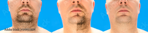 Before and after shaving. collage of young man with unformed, untrimmed, overgrown stubble, hair on his face and neck, half and with completely shaved beard. Isolated on blue background