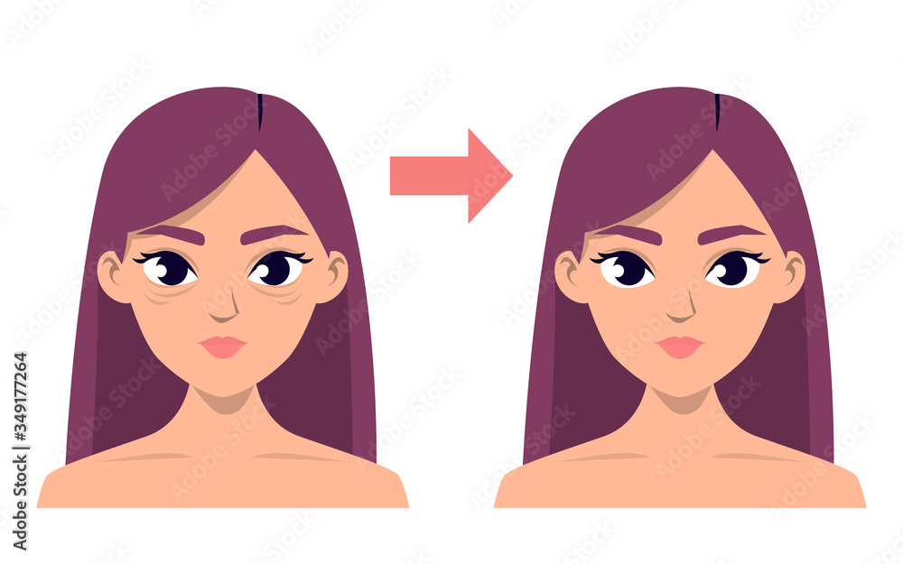 Blepharoplasty before and after vector isolated. Medical Blepharoplasty before and after vector isolated. Medical
