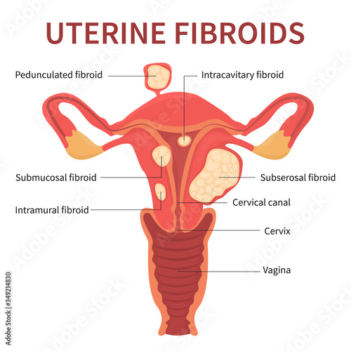 Isolated flat vector illustration of uterine fibroids, myoma, uterine leiomyomas on white background mentioning pedunculated, intracavitary, submucosal, subserosal.