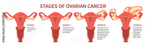 Flat vector illustration of ovarian cancer four stages mentioning ovaries, pelvic region, lining of abdomen and metastases. Woman reproductive system isolated on white background inline scheme.