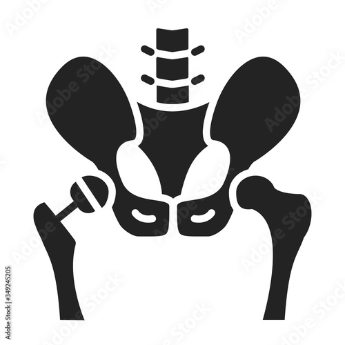 Arthroplasty glyph black icon. Hip replacement implant installed in the pelvis bone. Isolated vector element. 
