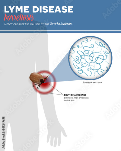 Lyme borreliosis infection caused by tick bite, colorful info poster