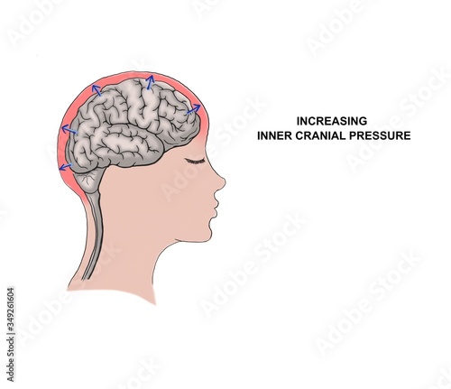 Illustration of the increasing inner cranial pressure. photo