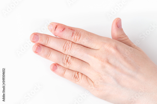 a left hand index finger with sores and scars after injury, tip of the finger bending downwards while the rest of the finger stay straight, deformity in the last phalangeal bone