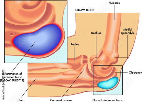 Medical illustration of elbow bursitis symptoms with annotations.