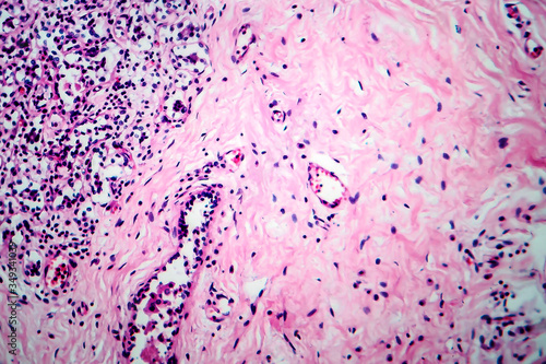 Breast fibroadenosis, light micrograph photo