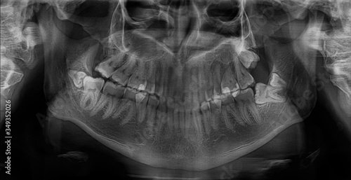 Dental x-ray of a mouth