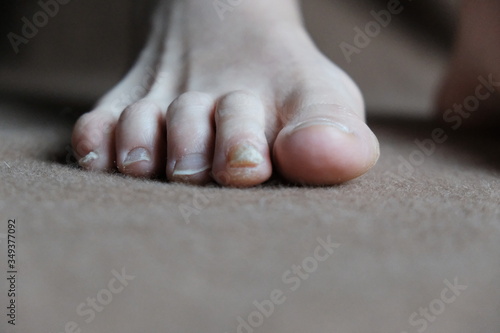 Warts corns on woman foot sole before appointment with a dermatologist.brown background.