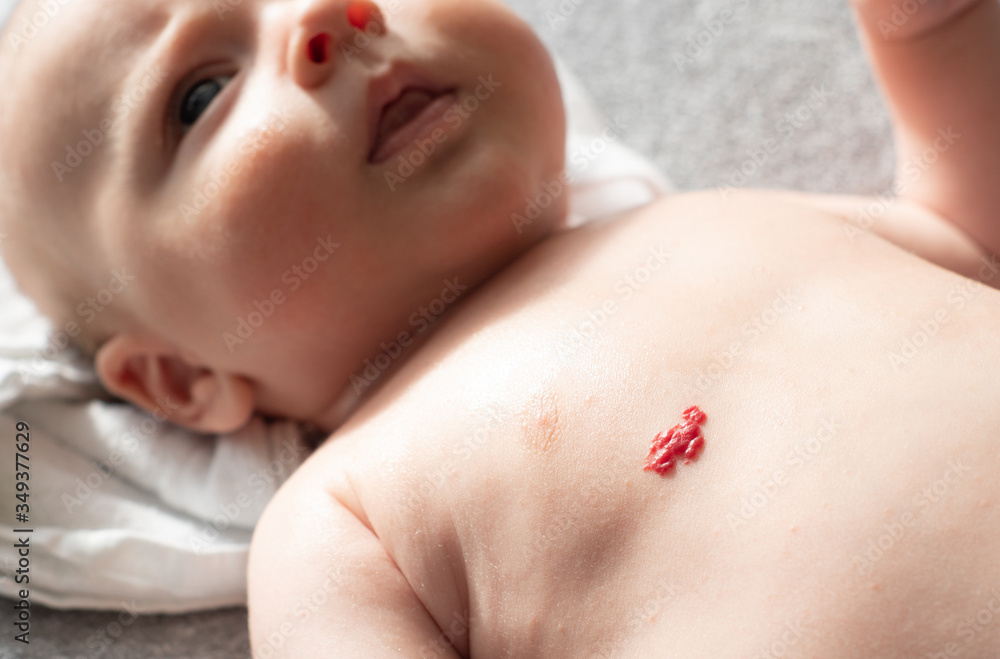 Strawberry nevus, hemangioma - a red birthmark of blood vessels on caucasian baby skin on his chest. Very common skin mark in children and infants.