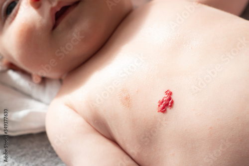Strawberry nevus, hemangioma - a red birthmark of blood vessels on  caucasian baby skin on his chest. Very common skin mark in children and  infants. Stock Photo | Adobe Stock