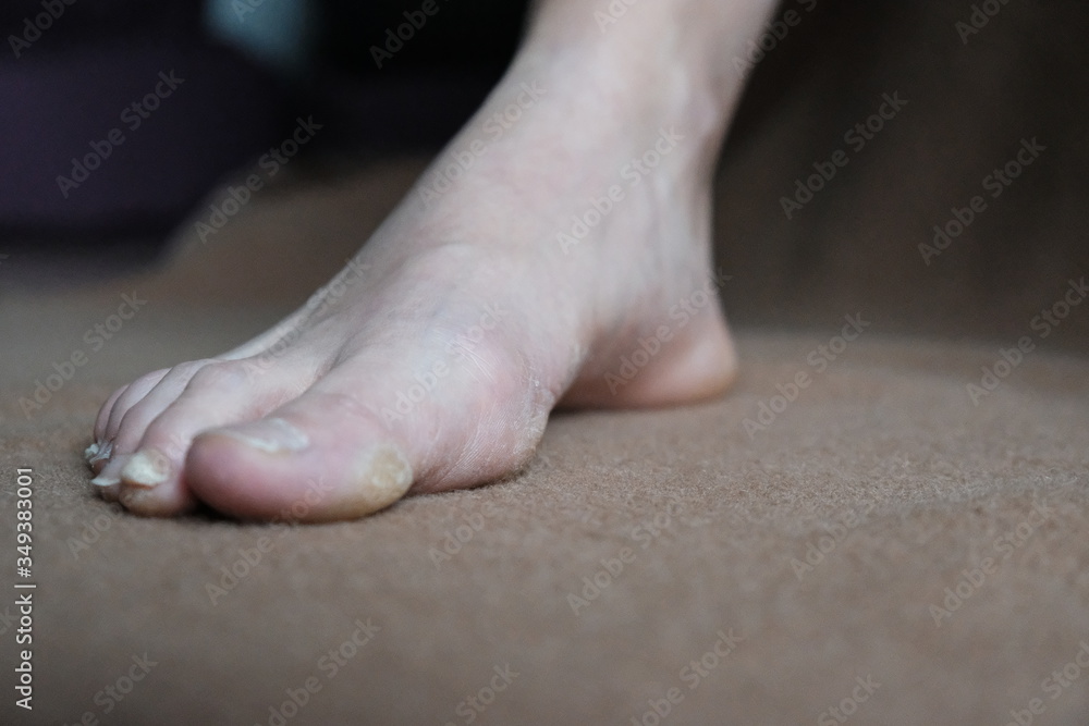 Warts corns on woman foot sole before appointment with a dermatologist.brown background. Warts corns on woman foot sole before appointment with a dermatologist.brown background.