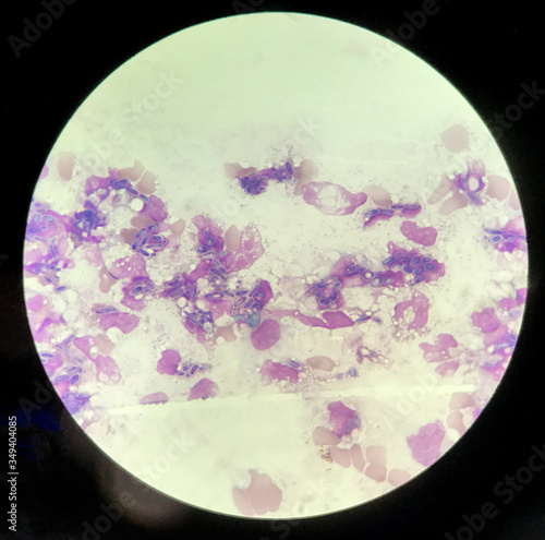 Yeast cells phagocytosis by white blood cell in blood smear.