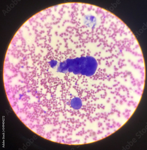 Atypical cells in body fluid smear.