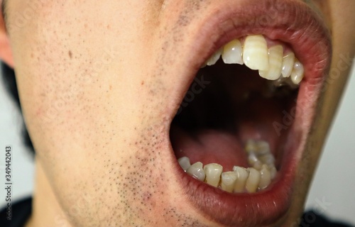 歯並びが悪い男性のクローズアップ