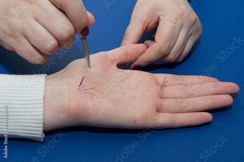 Treatment with acupuncture needles. Human hand