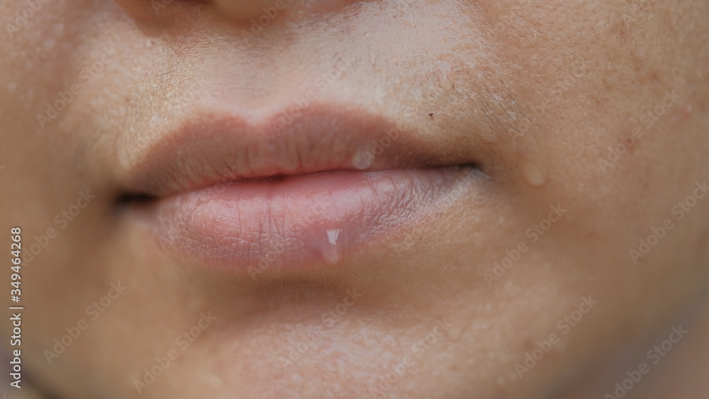 Sweating on the lips and face of women.
Sweating on the lips and face of women.