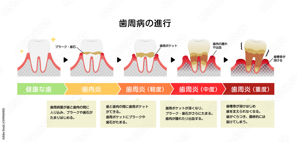 歯肉炎 歯周病のステージと症状イラスト Stock Vector Adobe Stock