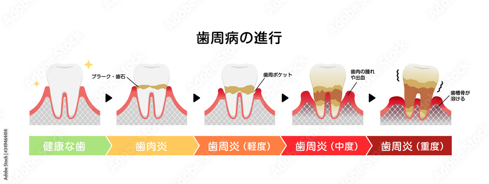 Fototapeta premium 歯肉炎・歯周病のステージと症状イラスト