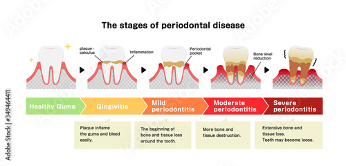 The stages of periodontitis disease vector illustration photo