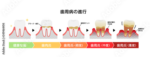 歯肉炎・歯周病のステージと症状イラスト
