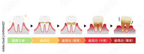 歯肉炎・歯周病のステージと症状イラスト photo