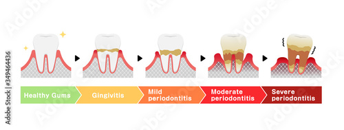 The stages of periodontitis disease vector illustration