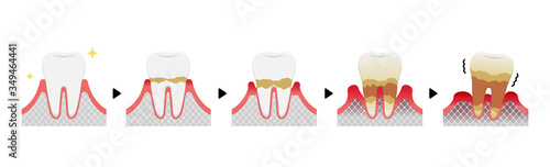 The stages of periodontitis disease vector illustration
