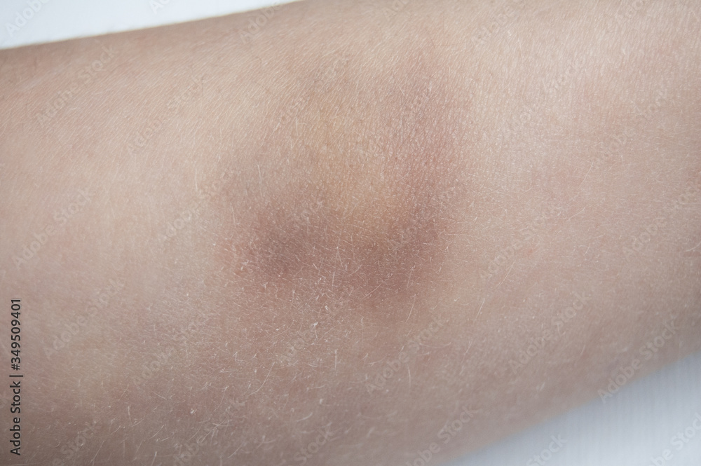 the bruise on my arm is close up the bruise on my arm is close up