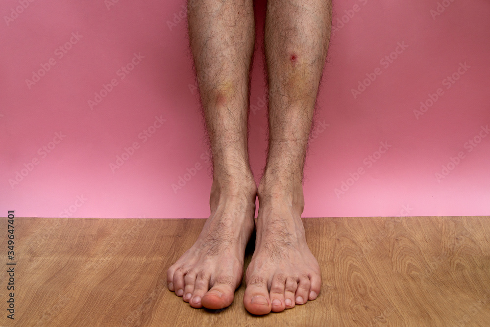 bruise and clotted blood on the leg of a young man bruise and clotted blood on the leg of a young man