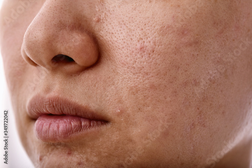 Skin problem with acne diseases, Close up woman face with whitehead pimples on mouth, Scar and oily greasy face, Beauty concept.