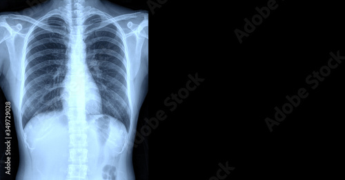 Foto x-ray chest lung