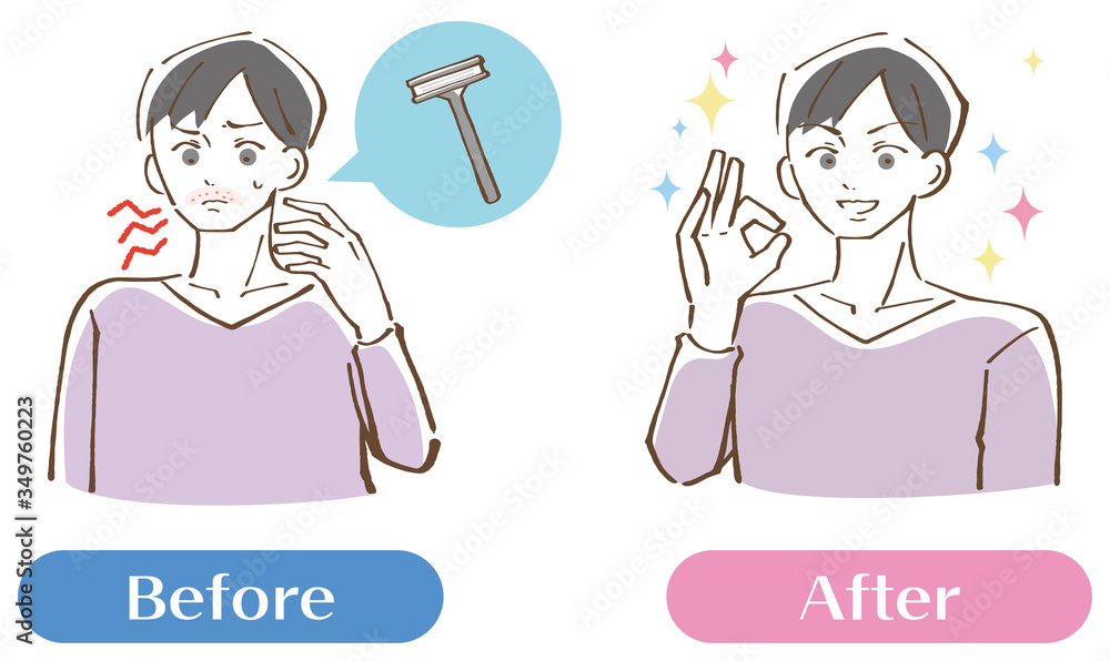 カミソリ負けを起こしている男性ビフォーアフターセット イラスト Stock Vector Adobe Stock カミソリ負けを起こしている男性ビフォーアフターセット イラスト Stock Vector Adobe Stock