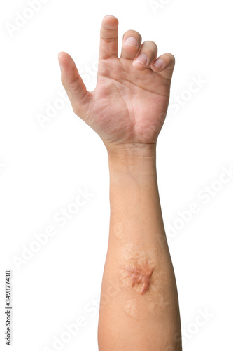 Wallpaper Mural Man arm and hand with Keloid scar (Hypertrophic Scar) on skin after accident isolated on white background. Torontodigital.ca