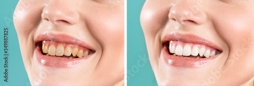 Close-up of a smiling woman before and after teeth whitening. Yellow  dark teeth. White  bright teeth. Medical procedure. Dentistry  dental health care.