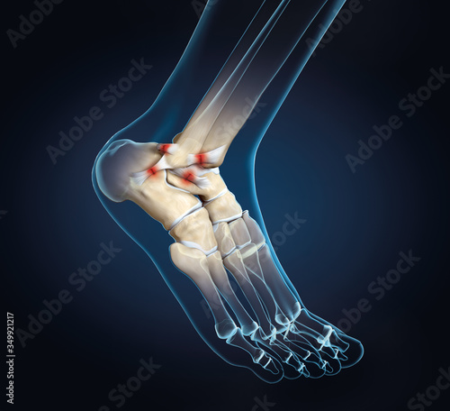 Torn ligament in ankle, medically 3D illustration
