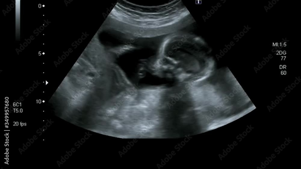 Fast motion of an ultrasound examination of a pregnant woman with an embryo and luminous lines, echography of fetus