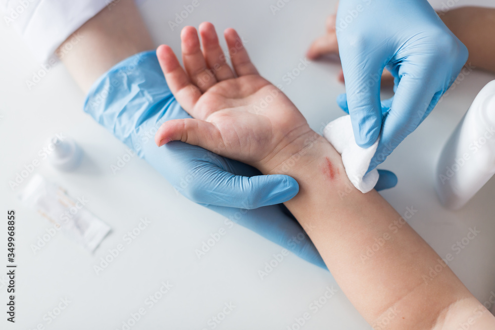 Fototapeta premium doctor treats a wound to a child, disinfection of a cut on a person, first aid to a child. Top view.