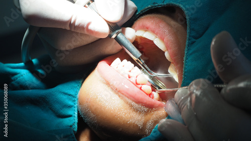 Quadro em tela Dentists are treating gingivitis by scaling.