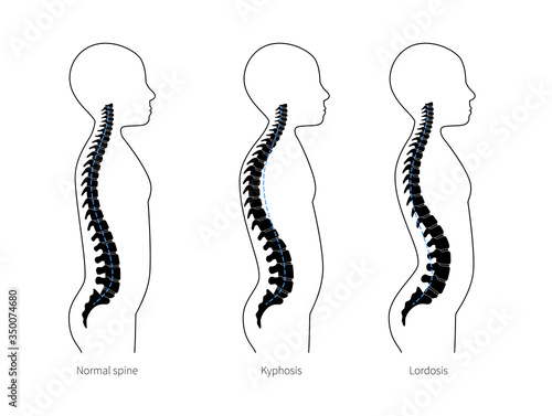 Kyphosis, lordosis flat vector illustration.