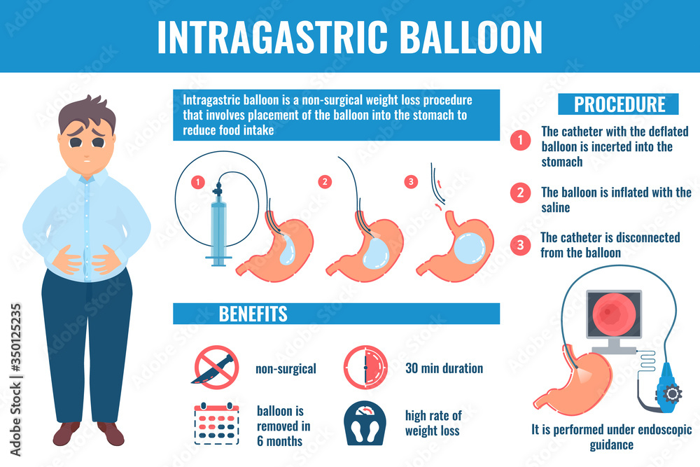 Intragastric balloon medical infographic banner. Benefits and medical procedure phases. Male