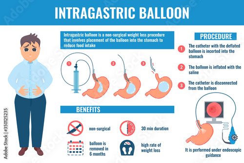 Intragastric balloon medical infographic banner.  Benefits and medical procedure phases.  Male patient losing weight with gastric balloon in stomach. Health care concept. Vector illustration.