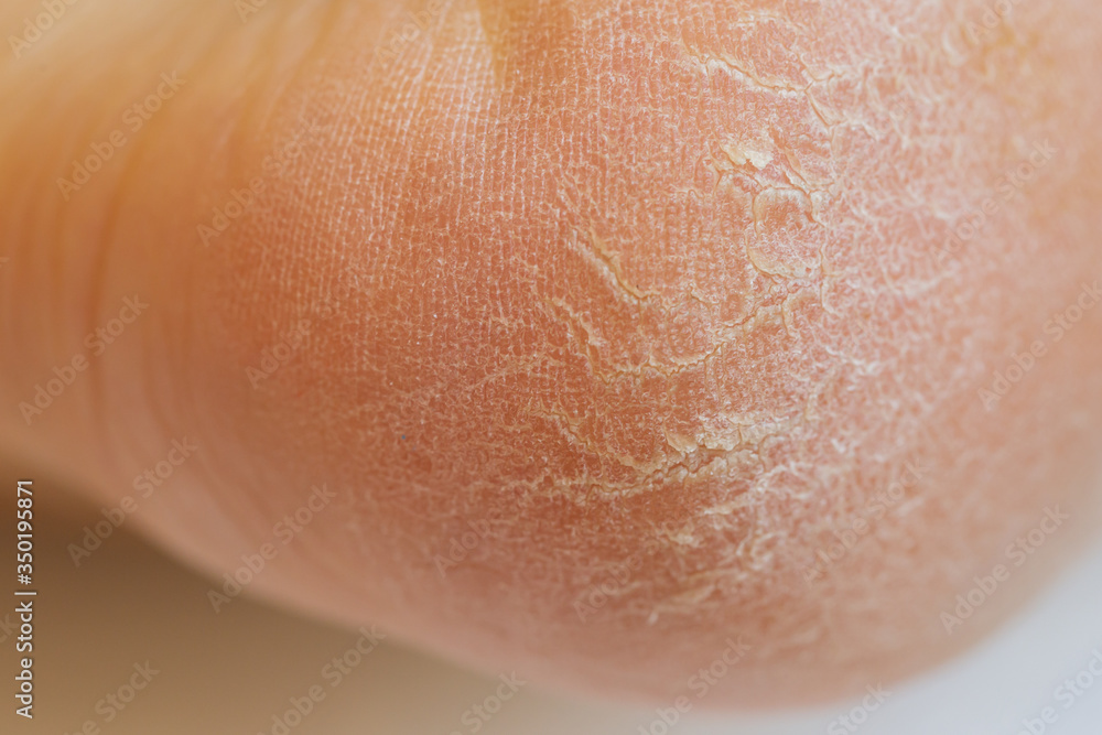 Fototapeta premium Closeup of horny skin on a heel