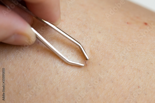 Removing ingrown hair with tweezer after shaving legs