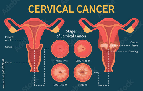 Cervical cancer infographic. Stage of disease. Female reproductive system. Progress of the spread of infected cells due to the virus. Dysplasia and ectropion.