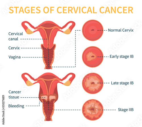 Stages of cervical cancer. Women s reproductive system. The effect of papillomavirus on the cervix. Vector infographic.