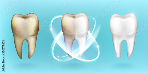 Clean and dirty tooth, whitening and clearing teeth process. Dental and oral cavity health care, enamel restoration, toothpaste advertising isolated on blue background Realistic 3d vector illustration